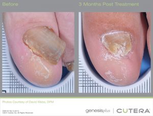 Toe Nail Fungus Treatments