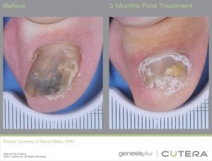 Toe Nail Fungus Treatments