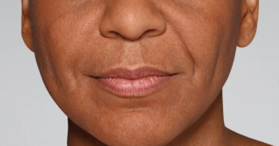 Dermal Fillers