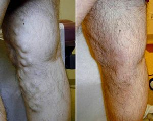 Laser Vein Removal