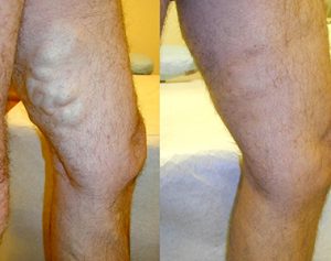 Varicose Veins Treatment