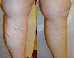 Laser Vein Removal