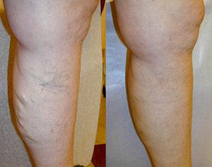 Laser Vein Removal