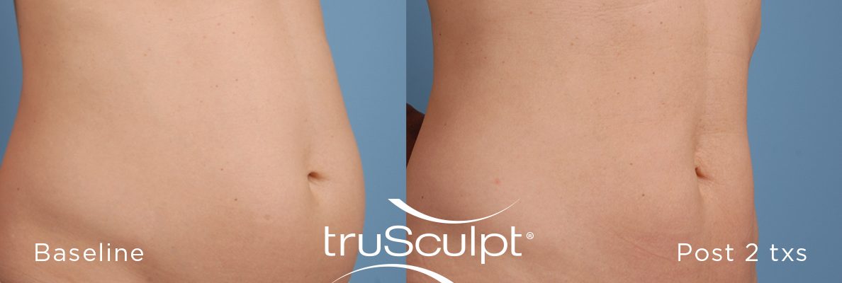 Body Sculpting and Cellulite Reduction