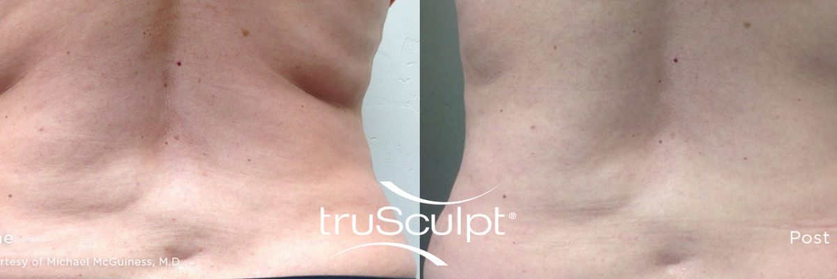 Body Sculpting and Cellulite Reduction