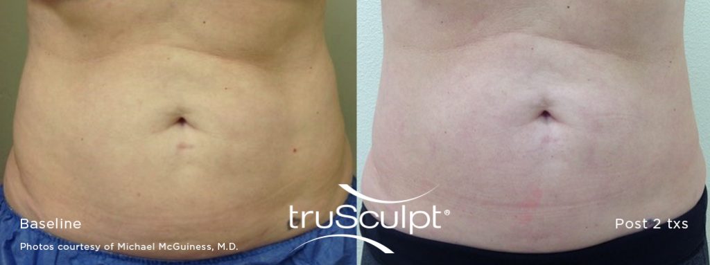 truSculpt 3D Before and After