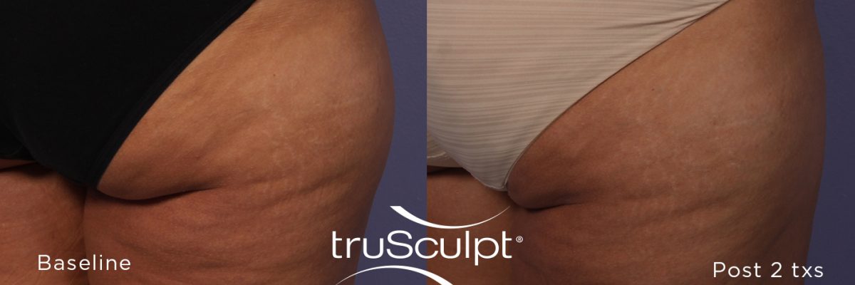 Body Sculpting and Cellulite Reduction