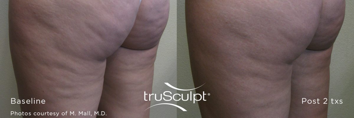 Body Sculpting and Cellulite Reduction